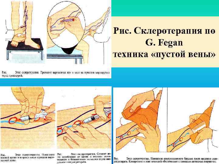 Рис. Склеротерапия по G. Fegan техника «пустой вены» 