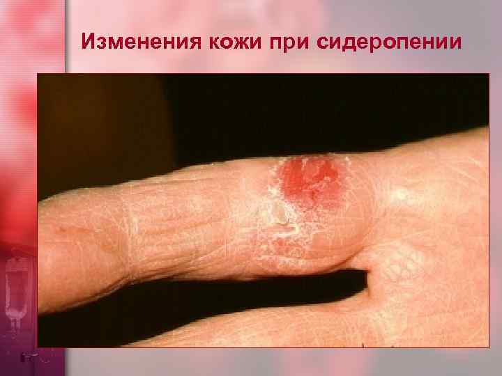 Изменения кожи при сидеропении 