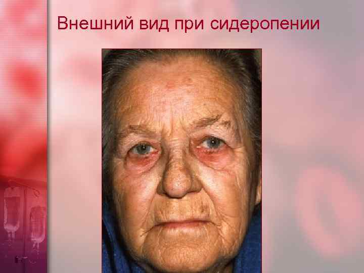 Внешний вид при сидеропении 