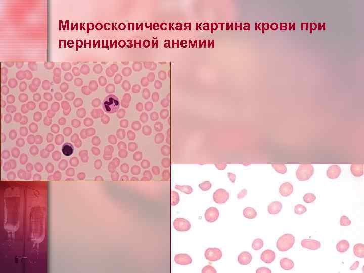 Микроскопическая картина крови при пернициозной анемии 