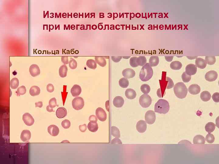 Изменения в эритроцитах при мегалобластных анемиях Кольца Кабо Тельца Жолли 