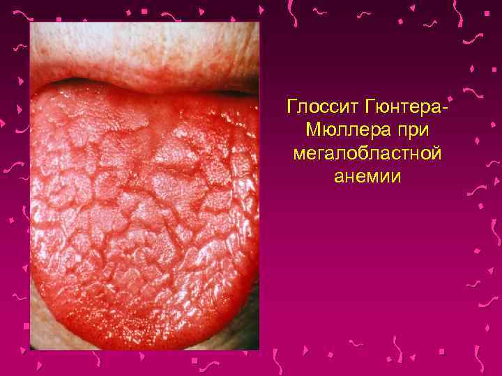 Глоссит Гюнтера. Мюллера при мегалобластной анемии 