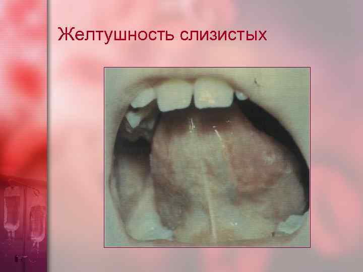 Желтушность слизистых 