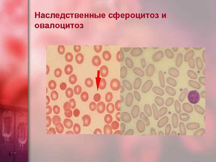 Наследственные сфероцитоз и овалоцитоз 