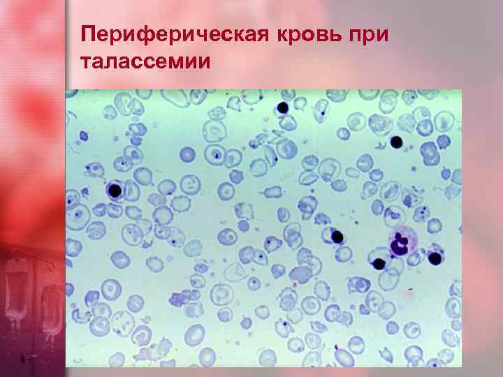 Периферическая кровь при талассемии 