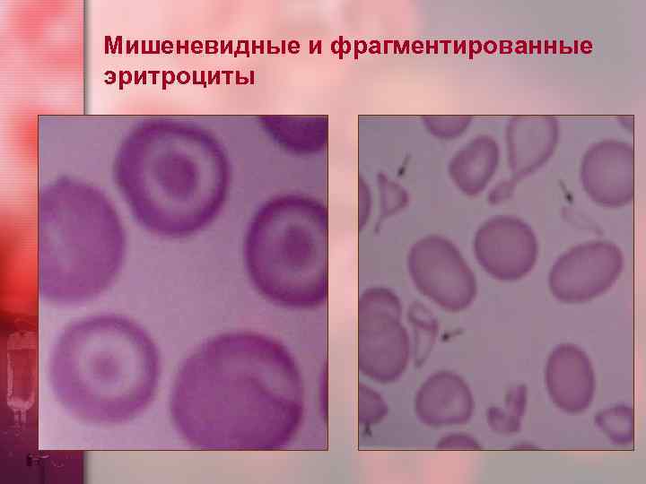 Мишеневидные и фрагментированные эритроциты 
