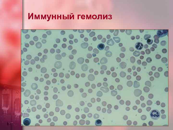 Иммунный гемолиз 