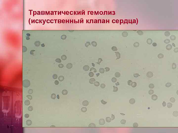 Травматический гемолиз (искусственный клапан сердца) 