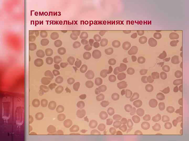 Гемолиз при тяжелых поражениях печени 
