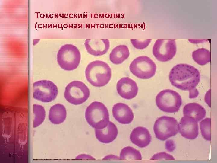 Токсический гемолиз (свинцовая интоксикация) 