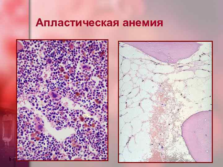 Апластическая анемия 
