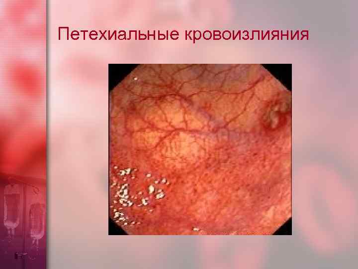 Петехиальные кровоизлияния 