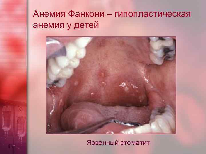 Анемия Фанкони – гипопластическая анемия у детей Язвенный стоматит 