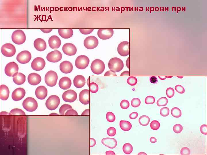 Микроскопическая картина крови при ЖДА 