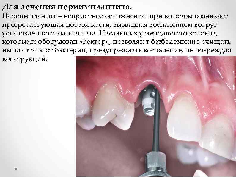 Для лечения периимплантита. Переимплантит – неприятное осложнение, при котором возникает прогрессирующая потеря кости, вызванная