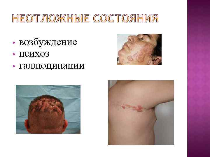  • • • возбуждение психоз галлюцинации 