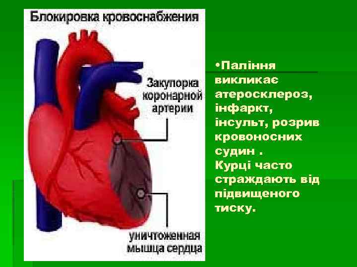  • Паління викликає атеросклероз, інфаркт, інсульт, розрив кровоносних судин. Курці часто страждають від