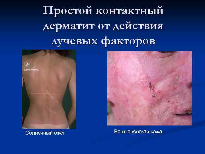 Простой контактный дерматит от действия лучевых факторов Солнечный ожог Рентгеновская кожа 