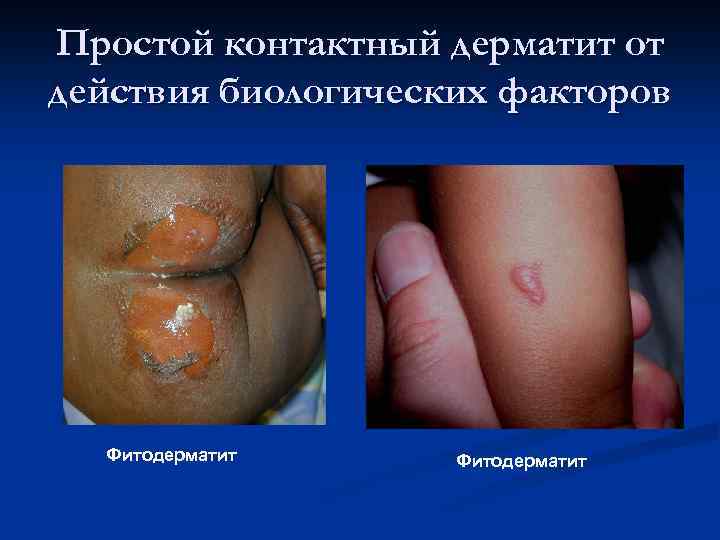 Простой контактный дерматит от действия биологических факторов Фитодерматит 
