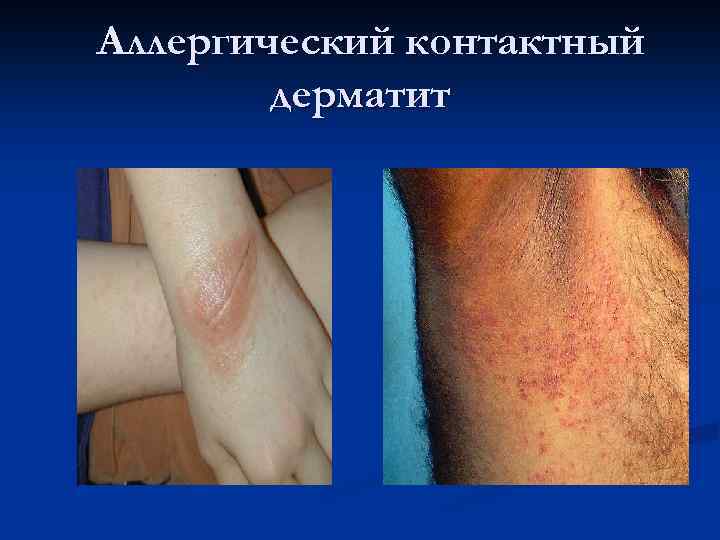 Аллергический контактный дерматит 