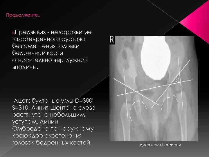 Продолженте. . o. Предвывих - недоразвитие тазобедренного сустава без смещения головки бедренной кости относительно