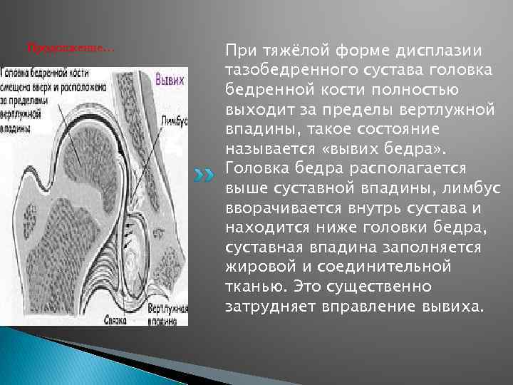 Продолжение… При тяжёлой форме дисплазии тазобедренного сустава головка бедренной кости полностью выходит за пределы