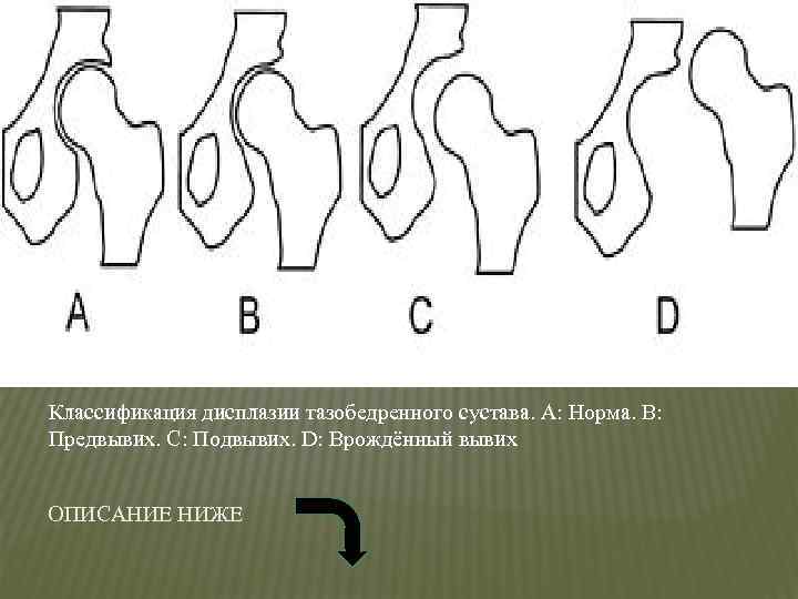 Дисплазия тазобедренного сустава у детей презентация