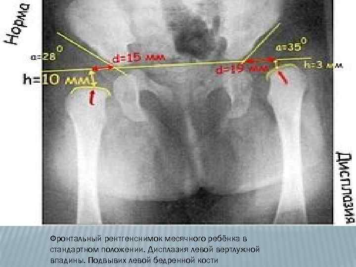 Фронтальный рентгенснимок месячного ребёнка в стандартном положении. Дисплазия левой вертлужной впадины. Подвывих левой бедренной