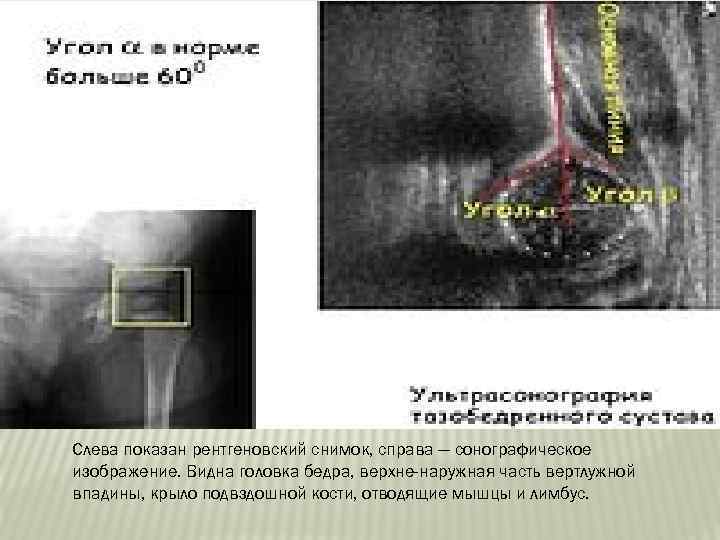 Слева показан рентгеновский снимок, справа — сонографическое изображение. Видна головка бедра, верхне-наружная часть вертлужной