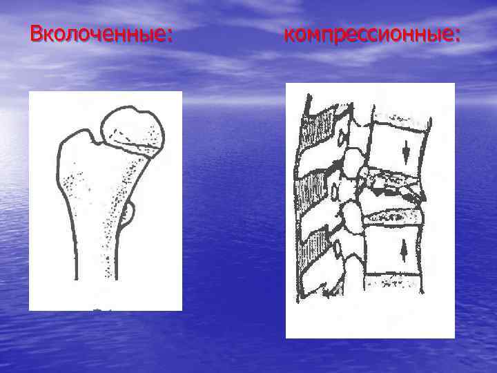 Вколоченные: компрессионные: 