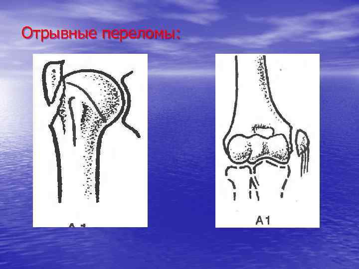 Отрывные переломы: 