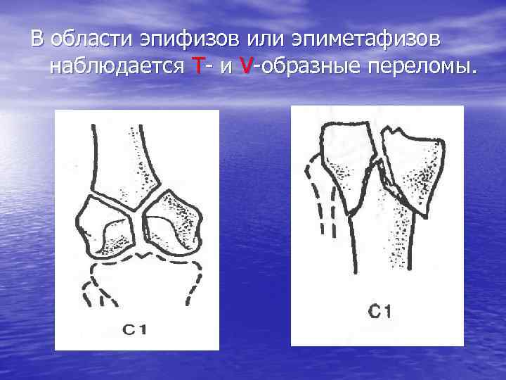 В области эпифизов или эпиметафизов наблюдается Т- и V-образные переломы. 