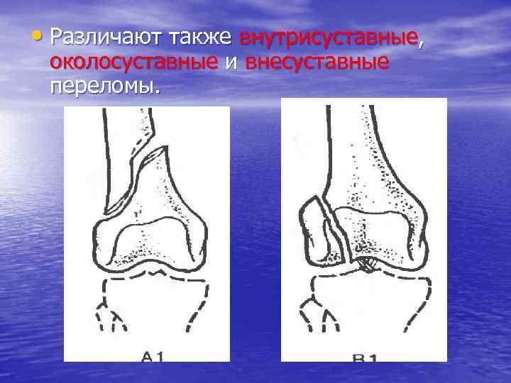  • Различают также внутрисуставные, околосуставные и внесуставные переломы. 