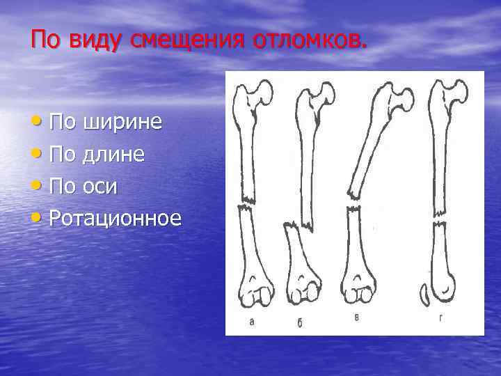 По виду смещения отломков. • По ширине • По длине • По оси •