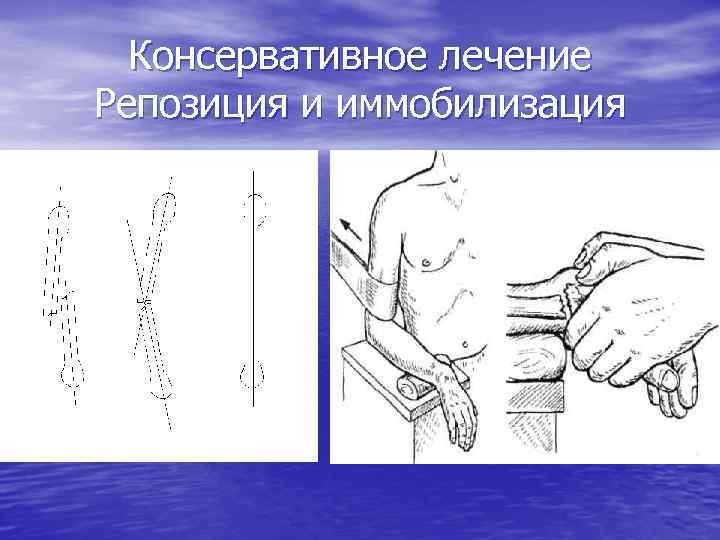 Консервативное лечение Репозиция и иммобилизация 
