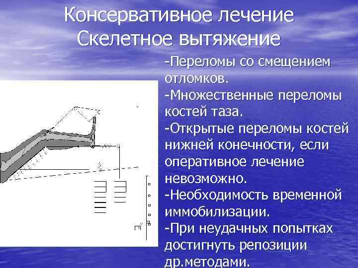 Консервативное лечение Скелетное вытяжение -Переломы со смещением отломков. -Множественные переломы костей таза. -Открытые переломы