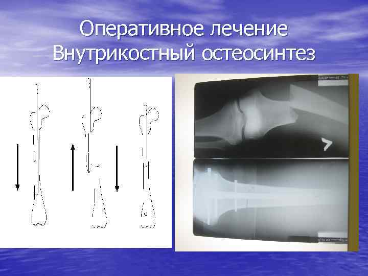 Оперативное лечение Внутрикостный остеосинтез 