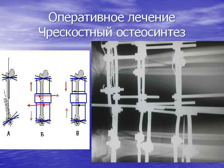 Оперативное лечение Чрескостный остеосинтез 