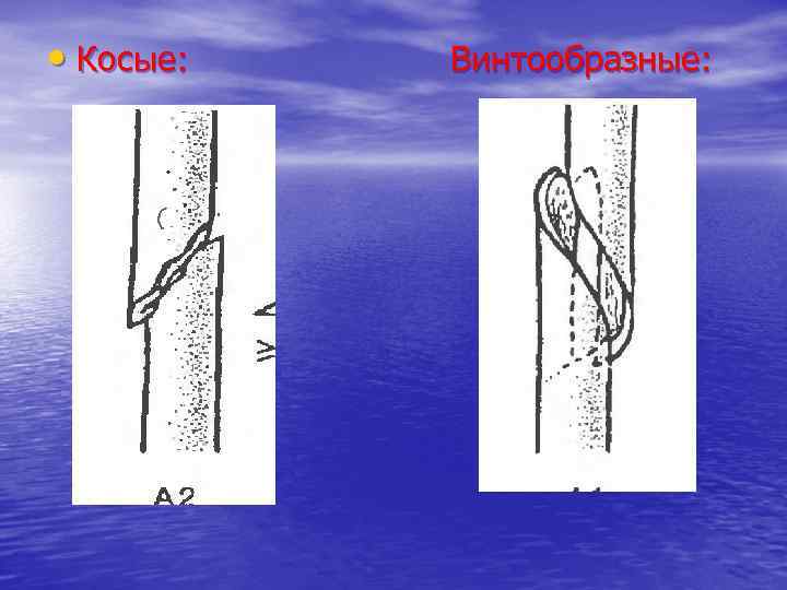  • Косые: Винтообразные: 