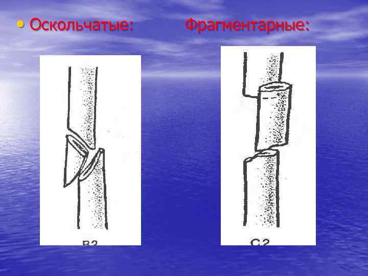  • Оскольчатые: Фрагментарные: 