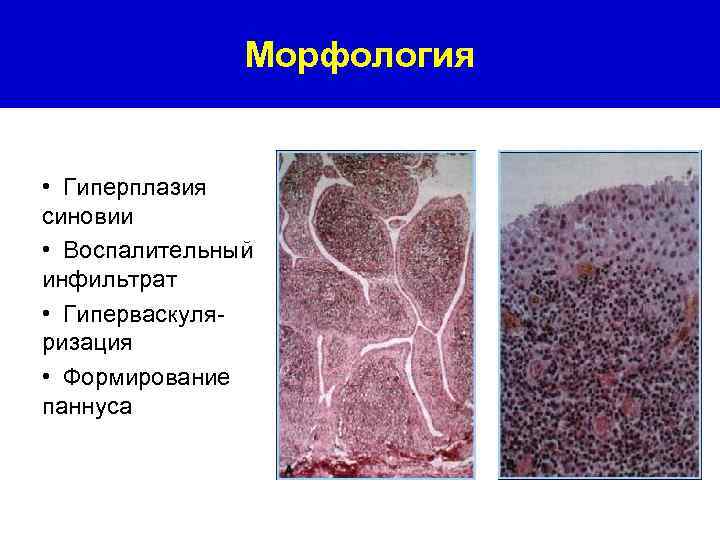 Морфология • Гиперплазия синовии • Воспалительный инфильтрат • Гиперваскуляризация • Формирование паннуса 