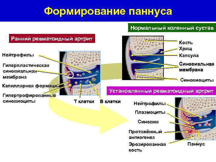 Формирование паннуса Нормальный коленный сустав Ранний ревматоидный артрит Кость Хрящ Капсула Нейтрофилы Синовиальная мембрана