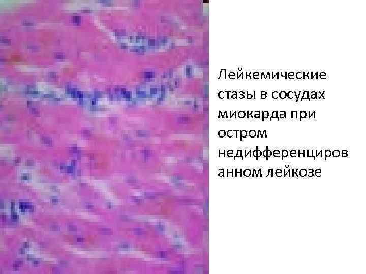  • Лейкемические стазы в сосудах миокарда при остром недифференциров анном лейкозе 