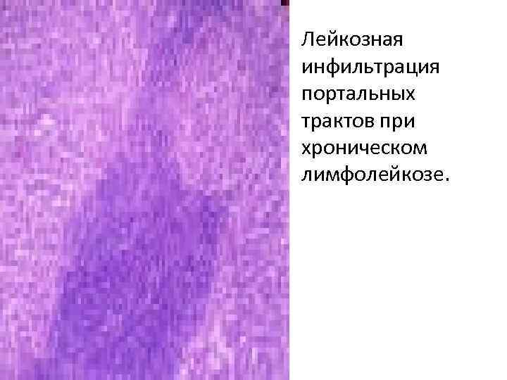  • Лейкозная инфильтрация портальных трактов при хроническом лимфолейкозе. 