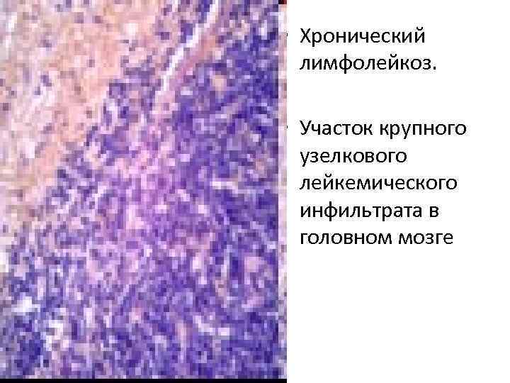  • Хронический лимфолейкоз. • Участок крупного узелкового лейкемического инфильтрата в головном мозге 