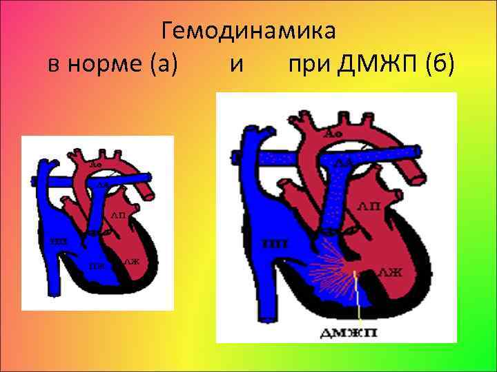 Гемодинамика дмжп у детей схема