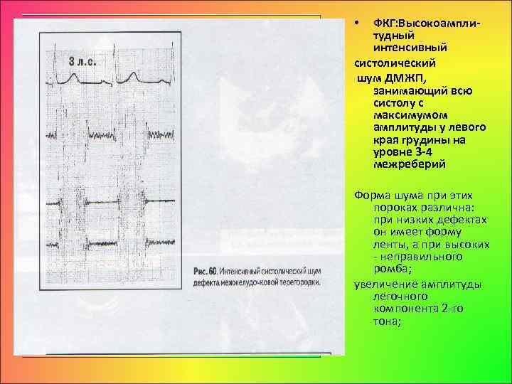 ФКГ: Высокоампли тудный интенсивный систолический шум ДМЖП, занимающий всю систолу с максимумом амплитуды у
