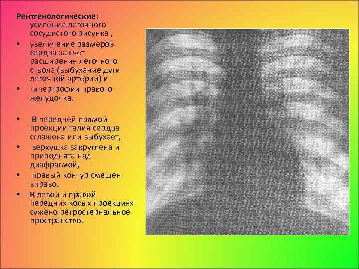 Что значит легочный рисунок усилен. Усиление сосудистого рисунка. Усиление сосудистого легочного рисунка. Легочный рисунок деформирован за счет сосудистого компонента. Легочный рисунок усилен за счет сосудистого компонента.