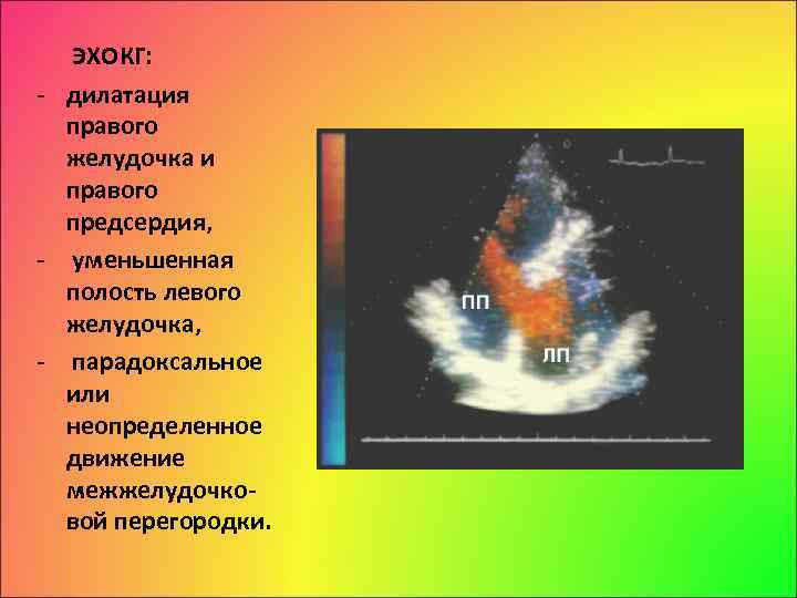 Дилатация левого предсердия степени. Дилатация левого желудочка ЭХОКГ. Дилатация правого желудочка причины. Дилатация правого предсердия.