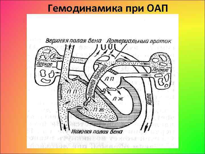 Открытый артериальный проток схема